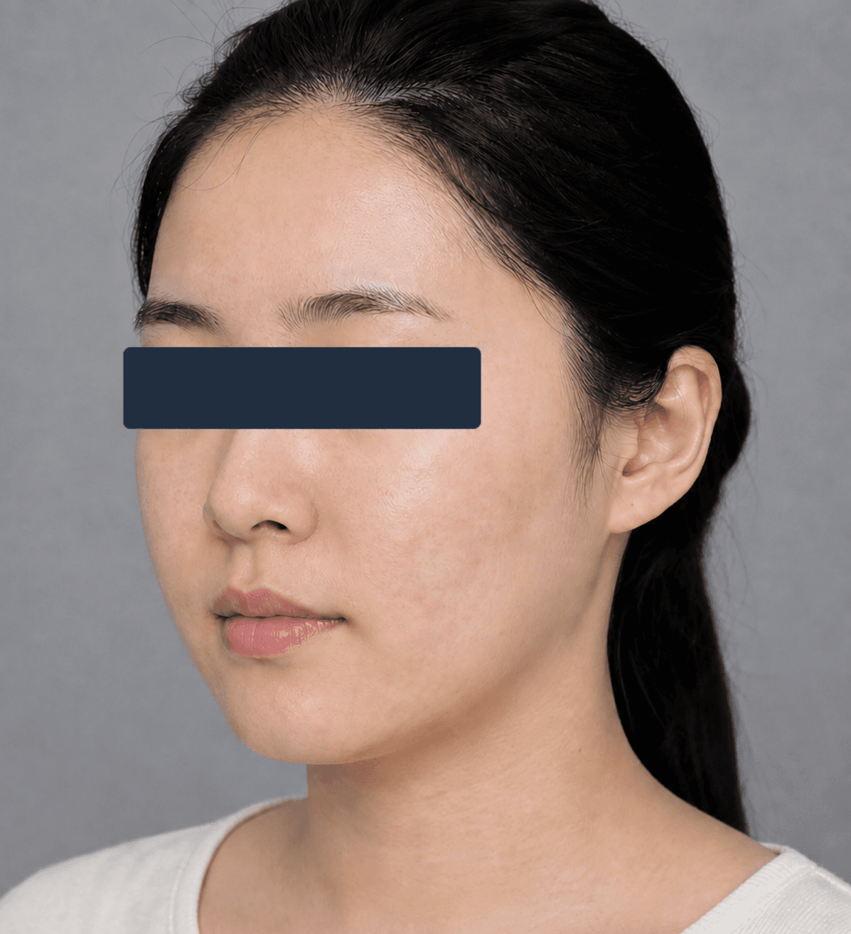 Inflammatory acne: after