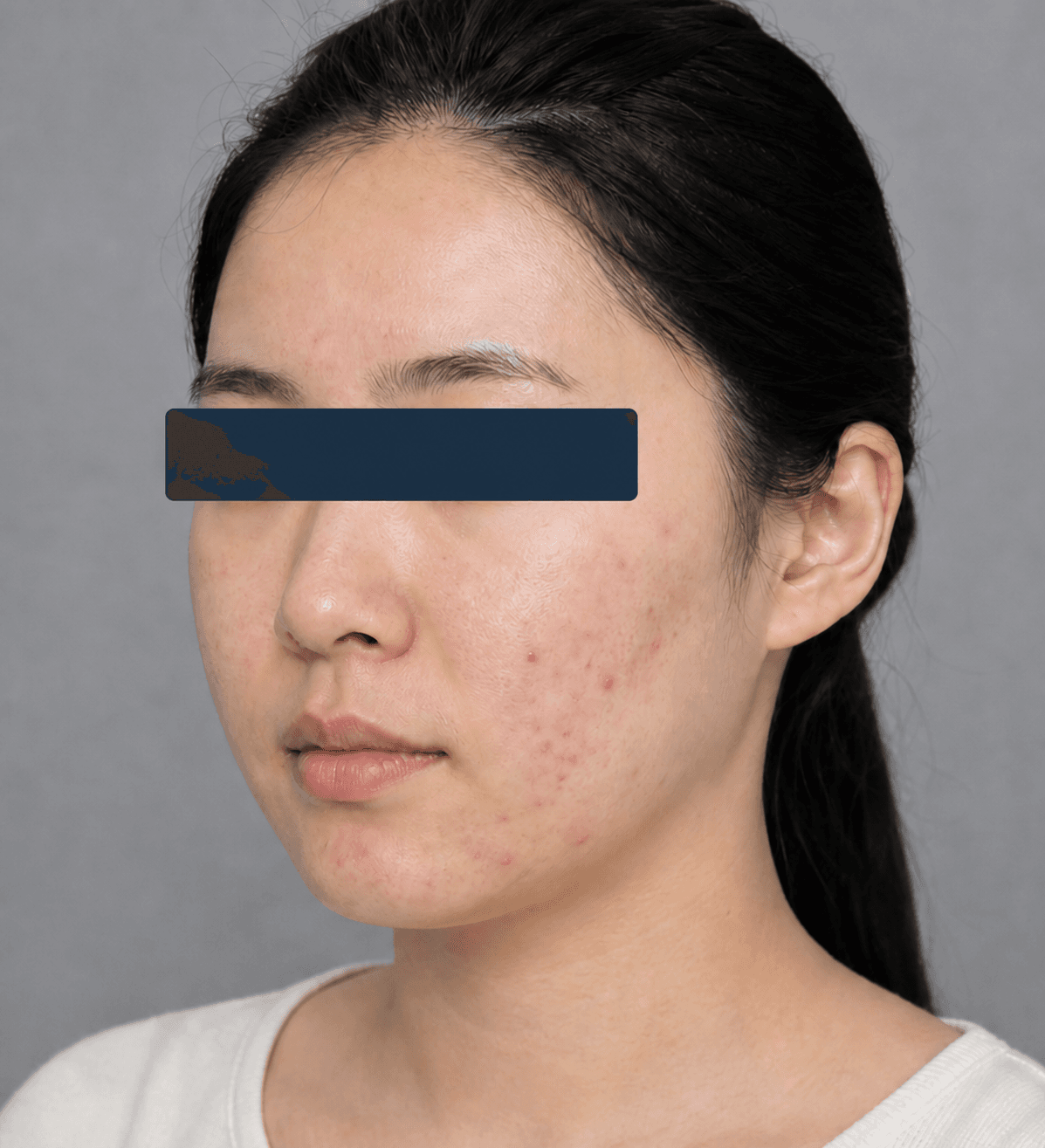Inflammatory acne: before