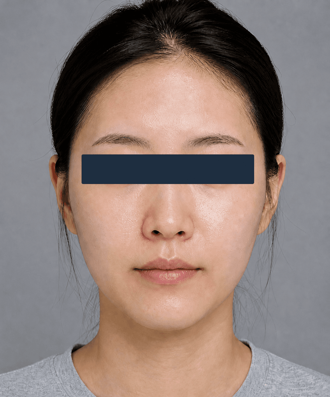 Dull, dehydrated skin: after