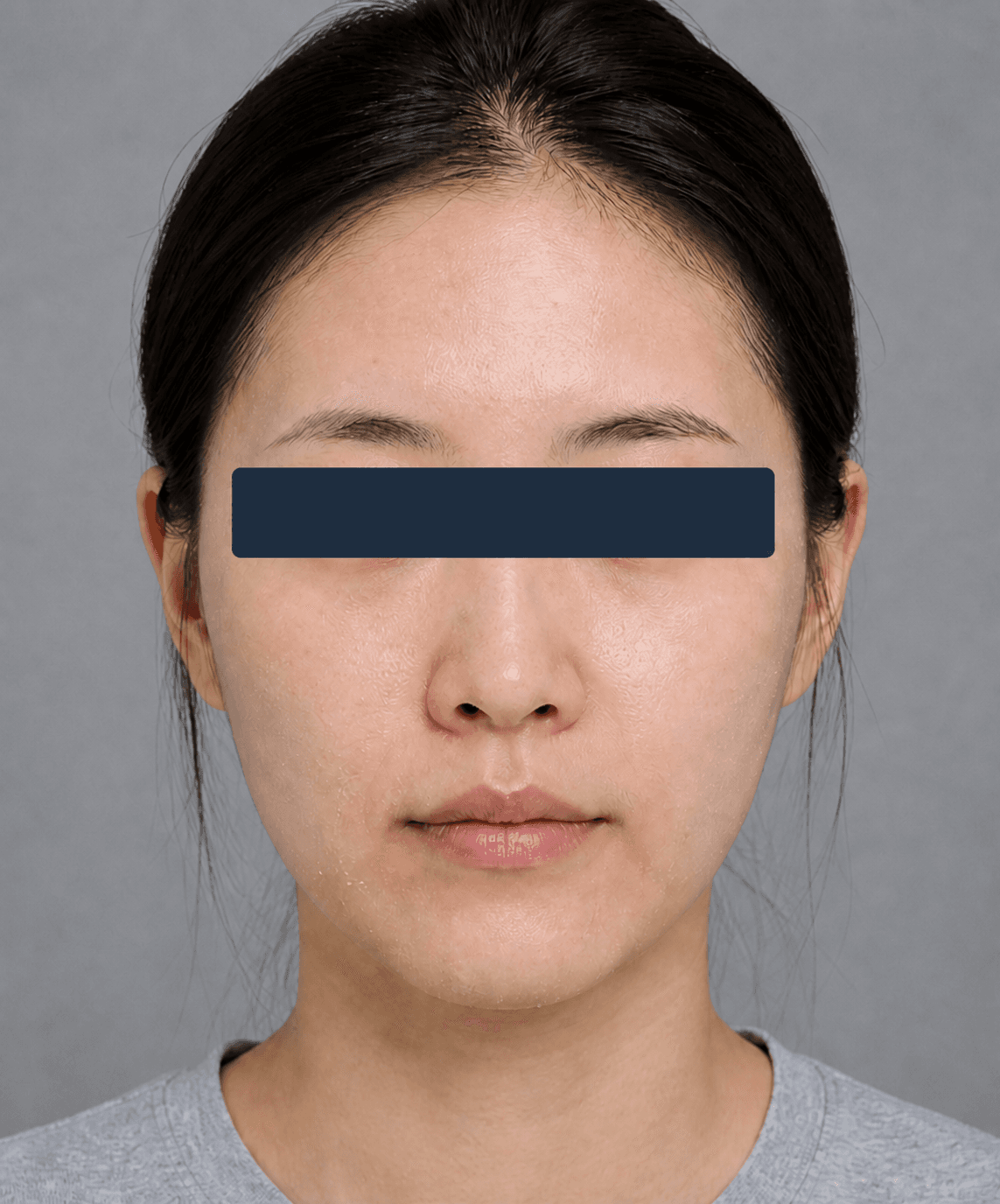 Dull, dehydrated skin: before