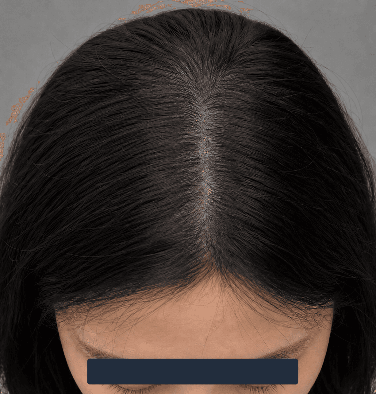 Diffuse hair thinning: after