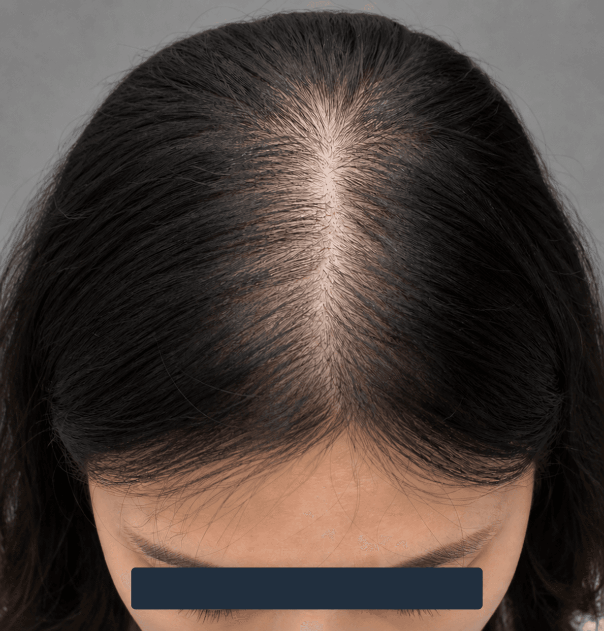Diffuse hair thinning: before