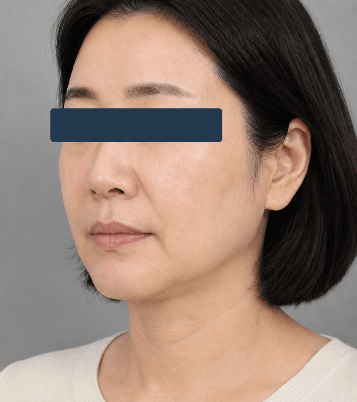 Lower-face laxity: after