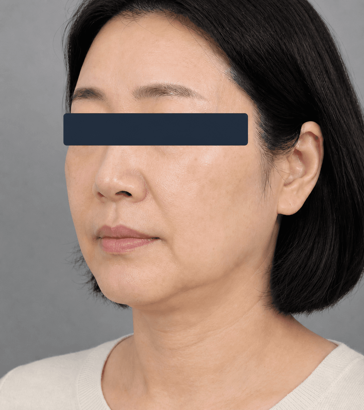 Lower-face laxity: before