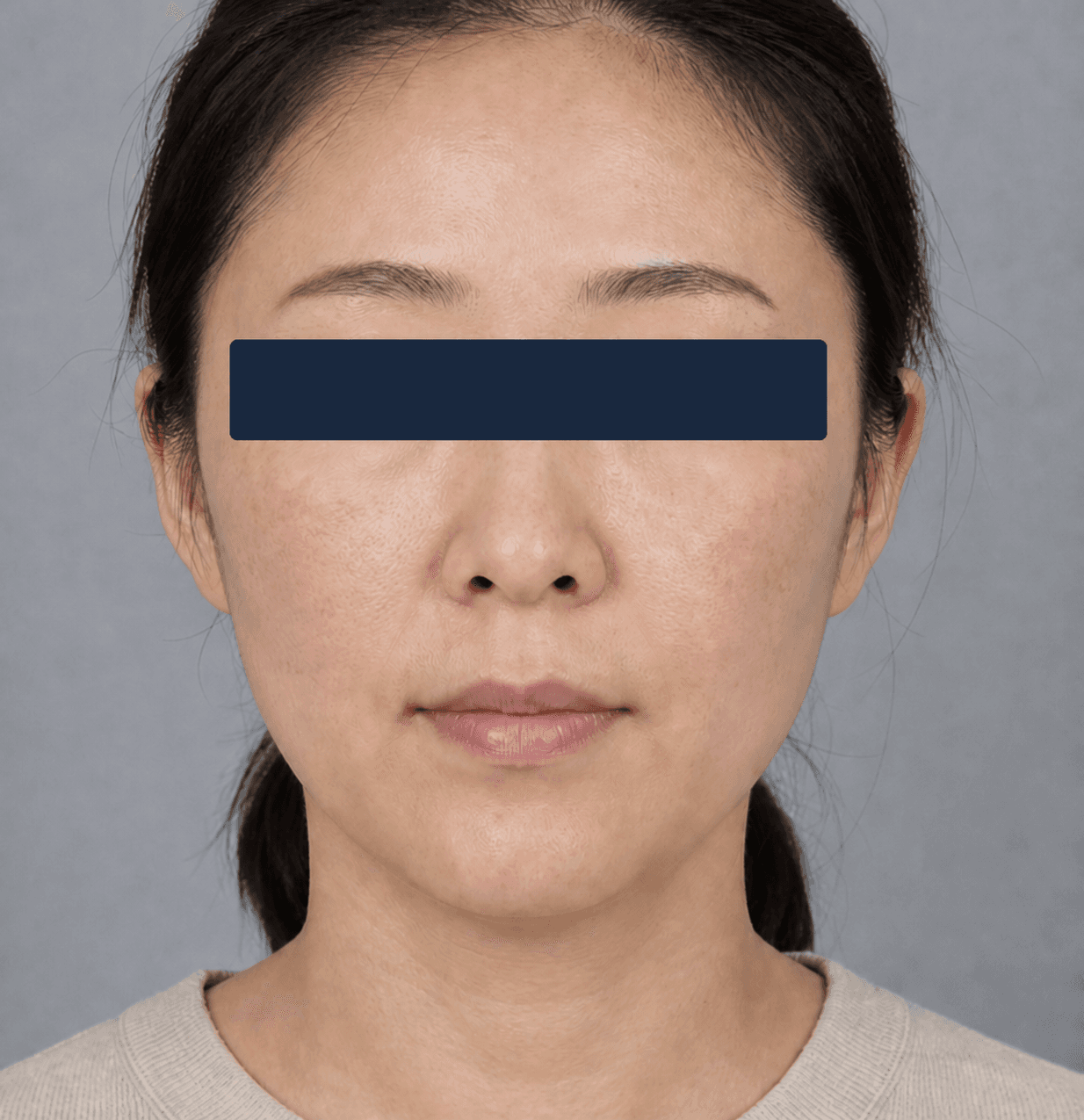 Melasma across the cheeks: after