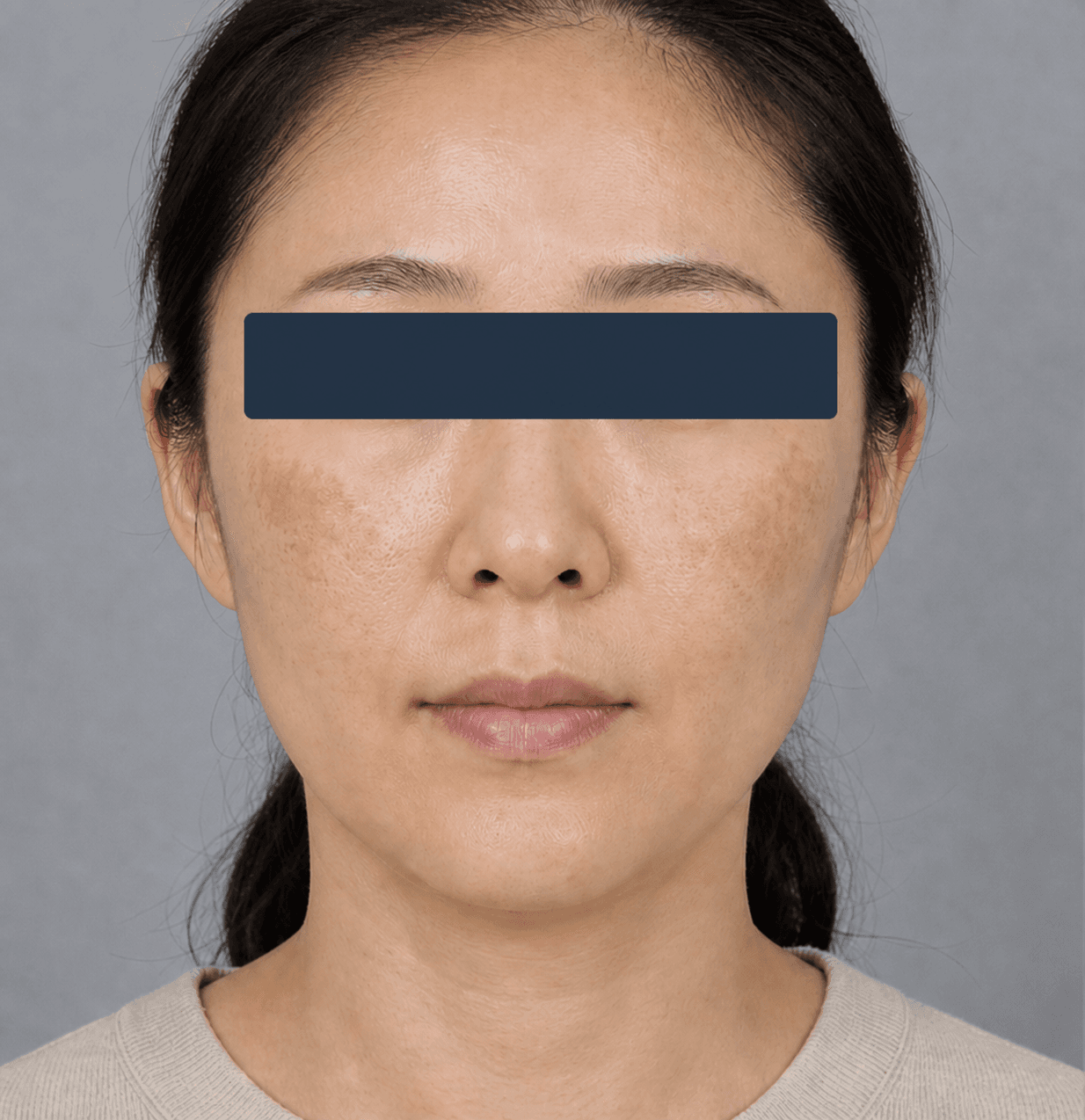 Melasma across the cheeks: before
