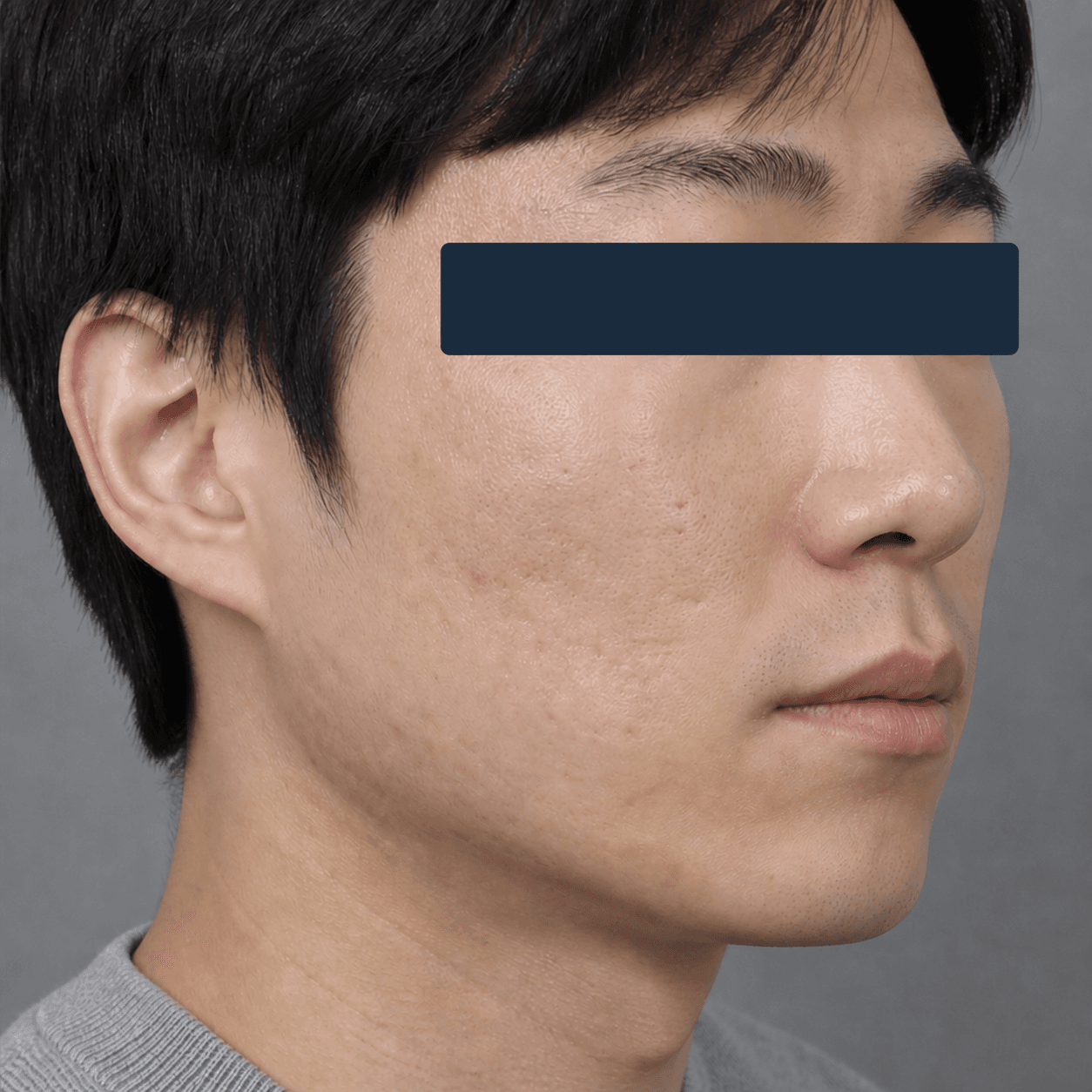 Rolling acne scars: after