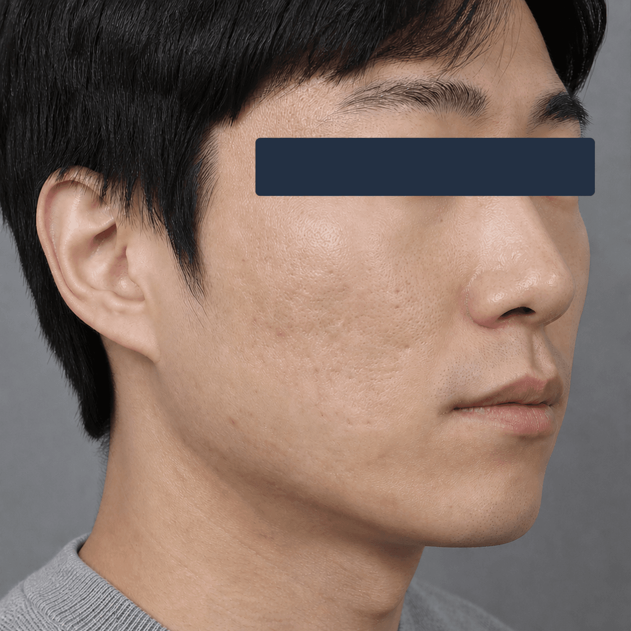 Rolling acne scars: before