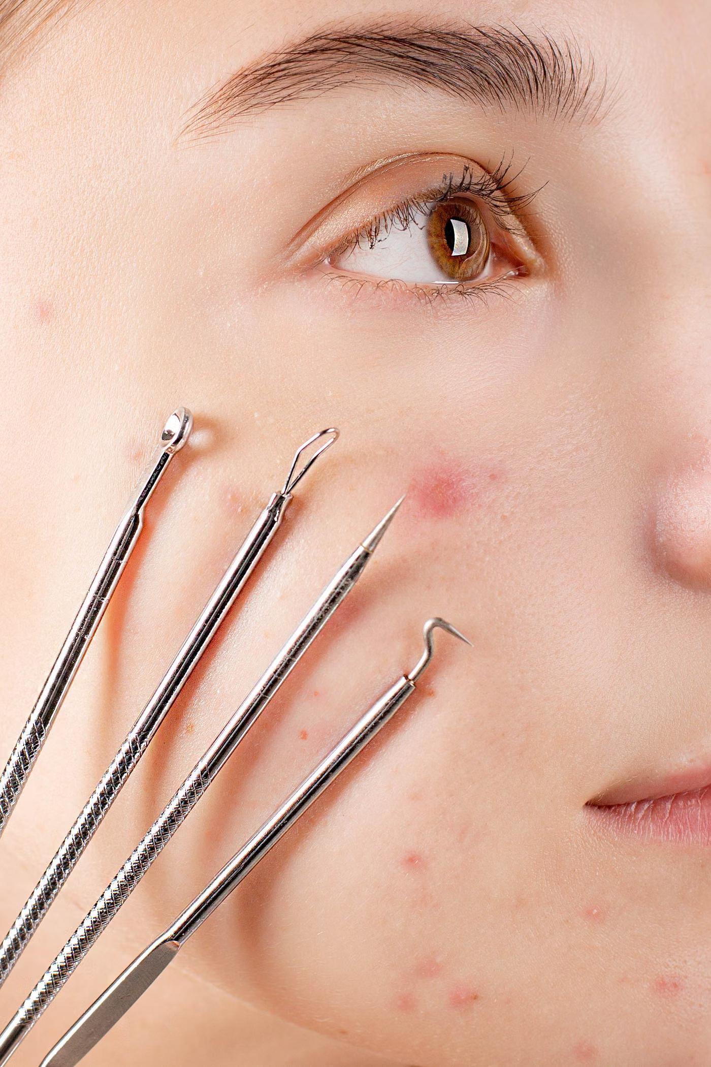 Acne Treatment: how it works