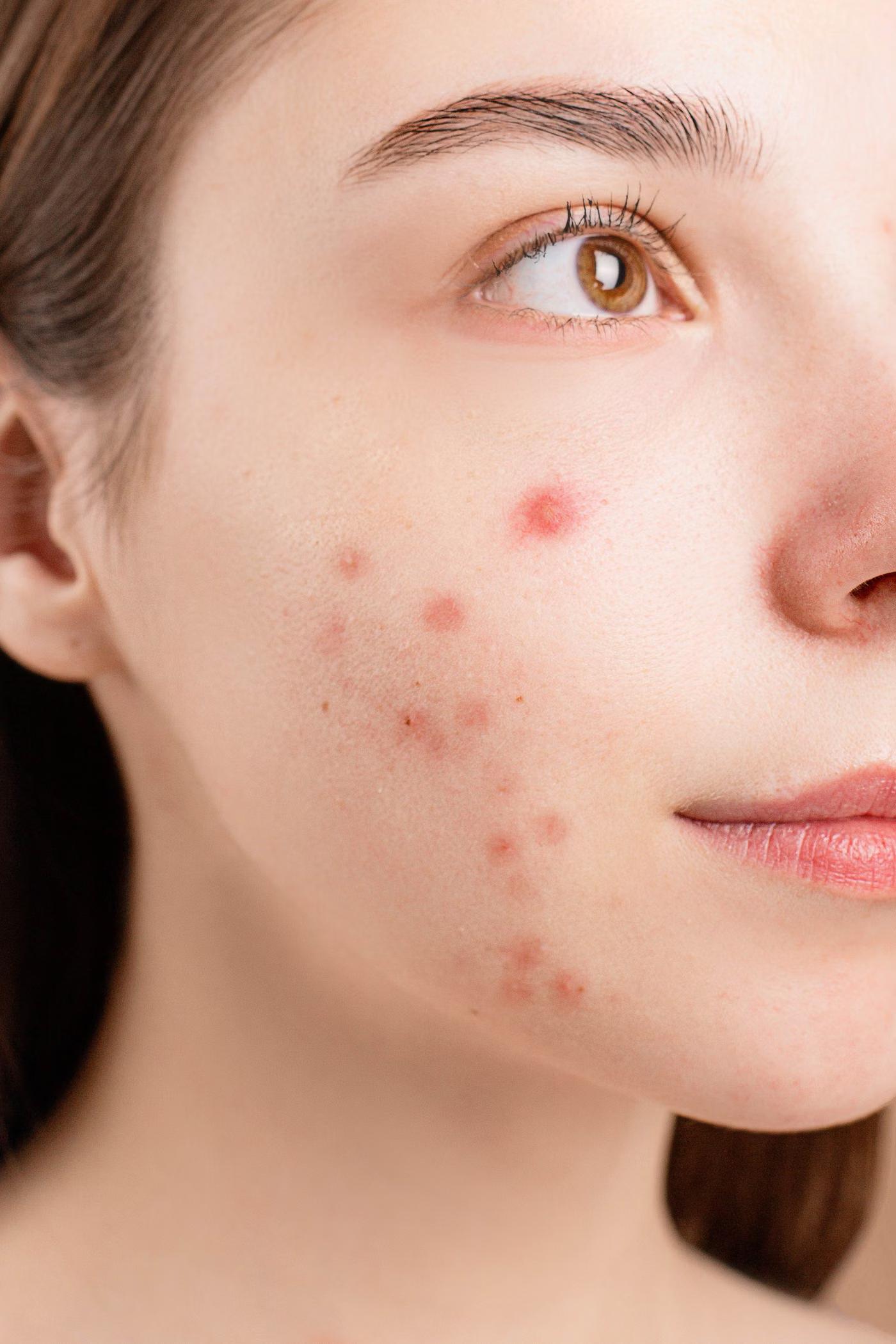 Acne Treatment: who it's for
