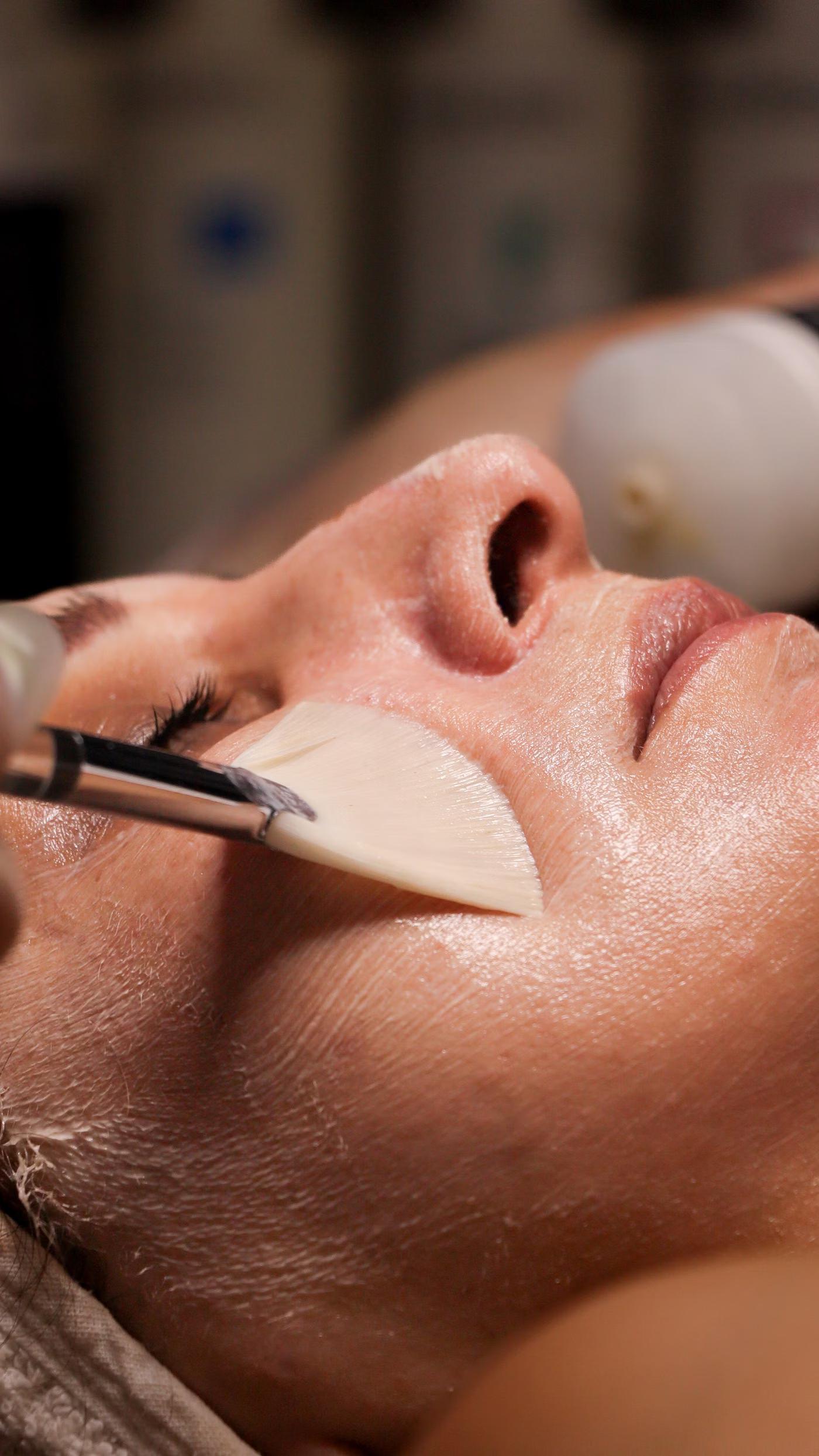 Chemical Peels: how it works