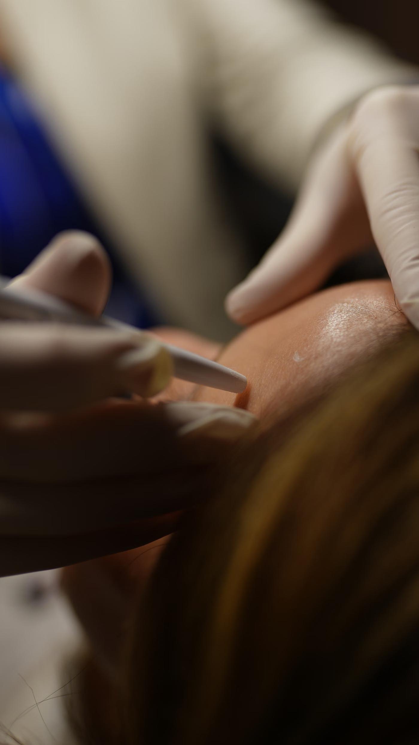 HIFU Skin Tightening: how it works