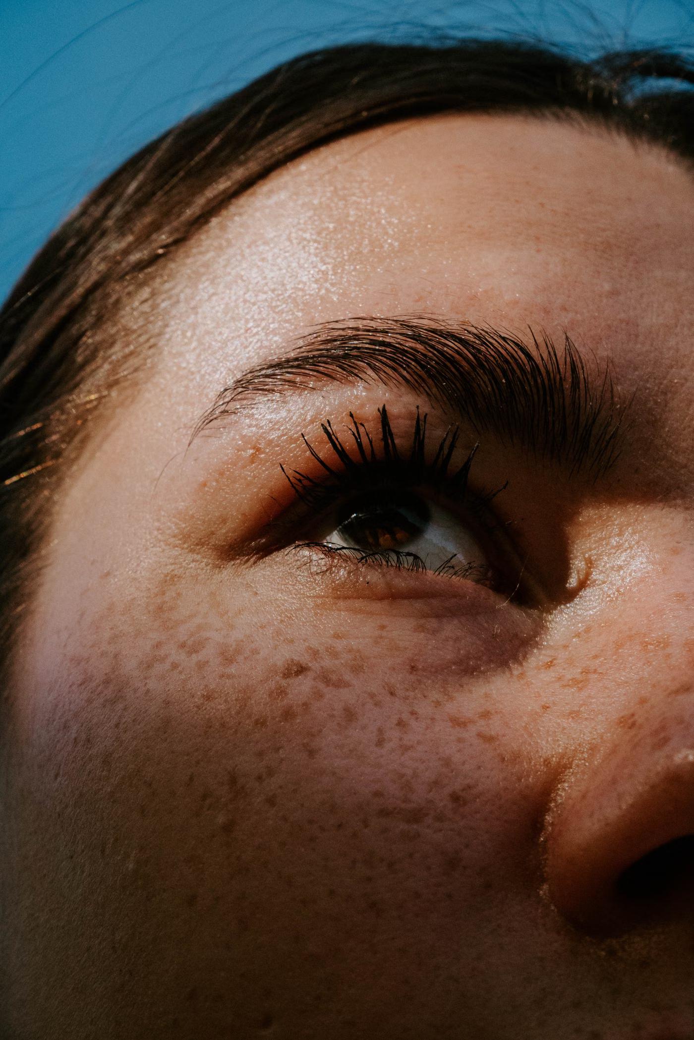 Melasma Treatment: what it addresses