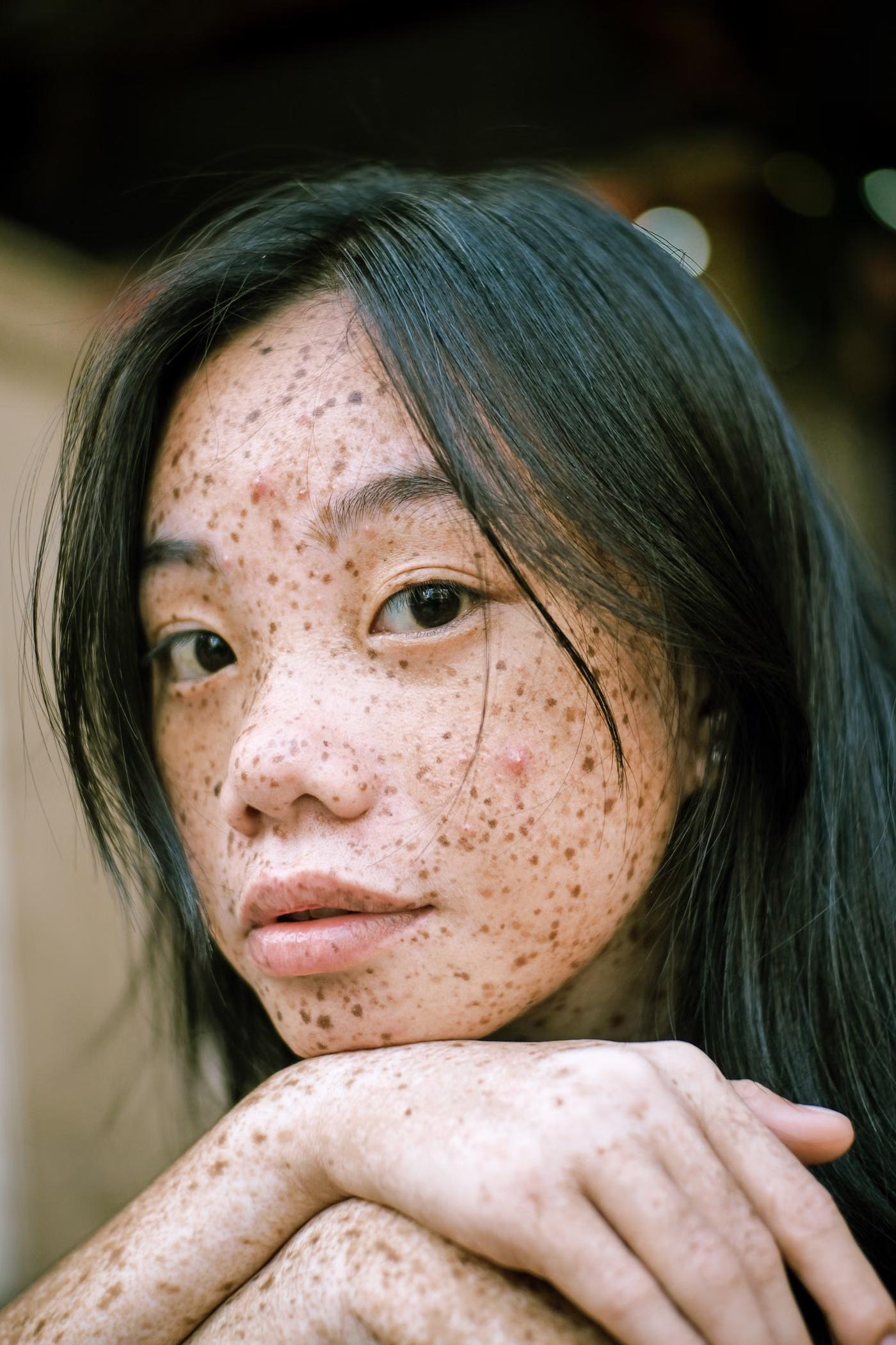 Pigmentation Treatment: what it addresses