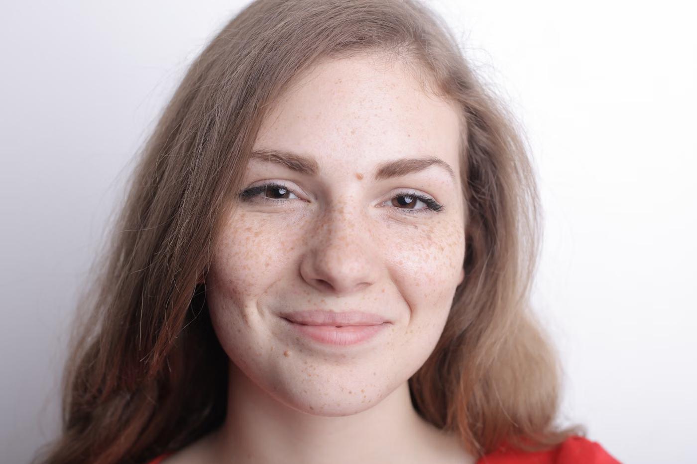 Pigmentation Treatment: who it's for