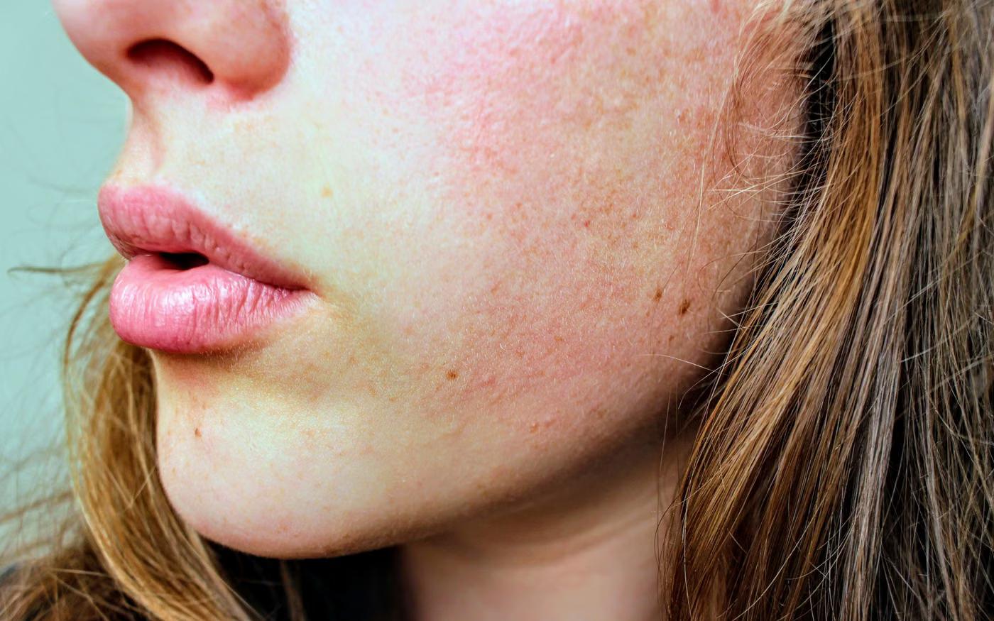 Rosacea Management: what it addresses