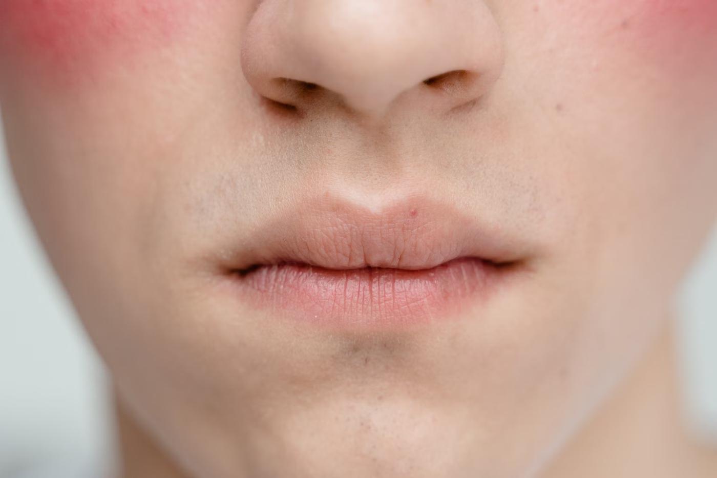 Rosacea Management: who it's for