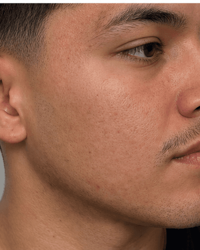 Active Acne Programme: after