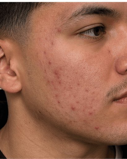 Active Acne Programme: before