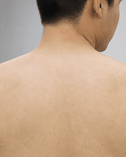Back & Chest Acne: after