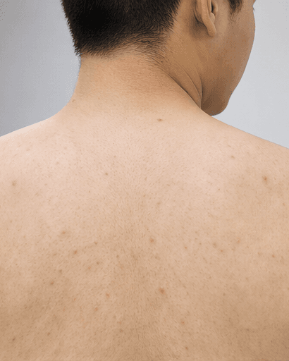Back & Chest Acne: before