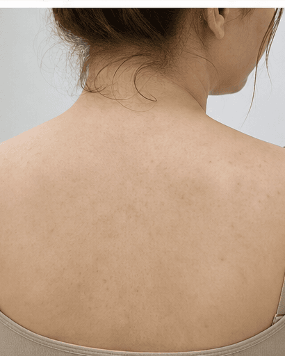 Back & Chest Acne: after