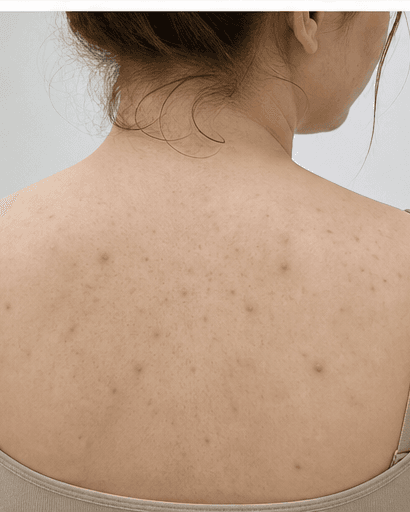 Back & Chest Acne: before