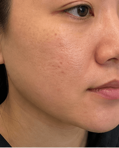 Chemical Peels: after