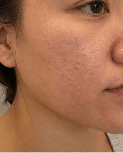 Chemical Peels: before