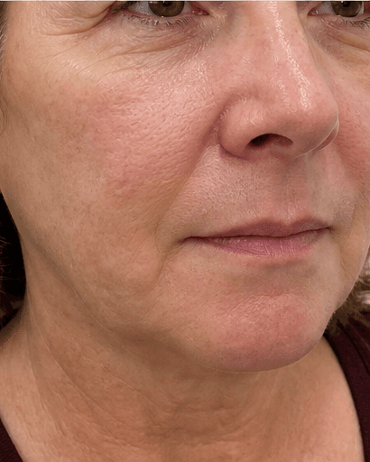 Chemical Peels: after