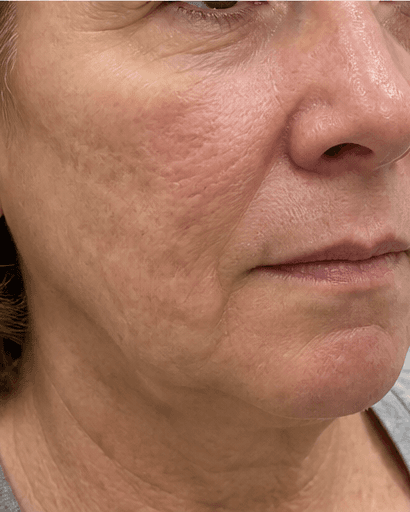 Chemical Peels: before