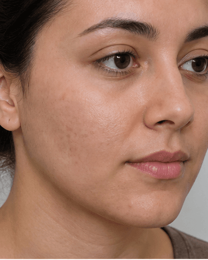 Hormonal Acne Assessment: after
