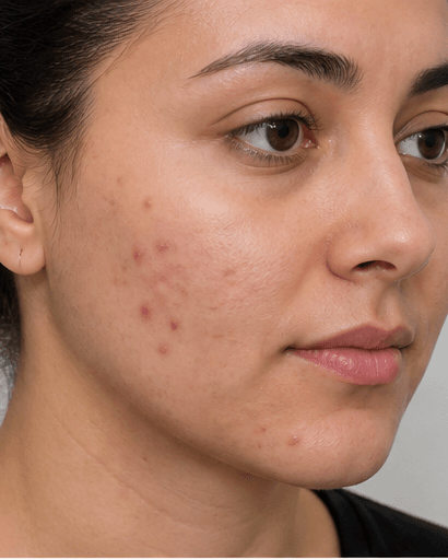Hormonal Acne Assessment: before