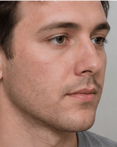 Hormonal Acne Assessment: after