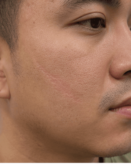 Hypertrophic Scar Treatment: after
