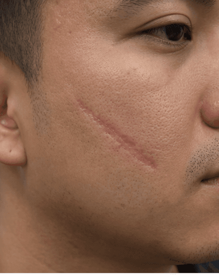 Hypertrophic Scar Treatment: before
