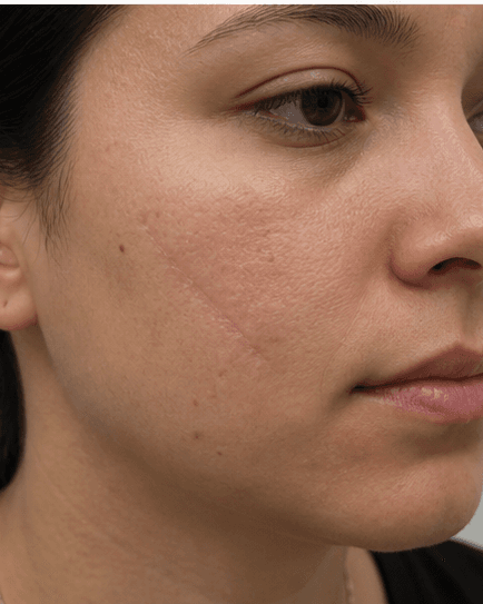 Hypertrophic Scar Treatment: after