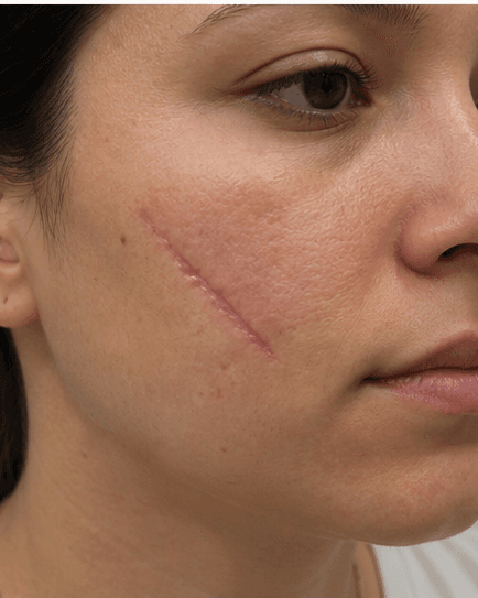 Hypertrophic Scar Treatment: before