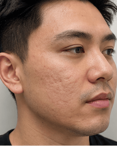 Oral Retinoid Programme: after