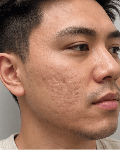 Oral Retinoid Programme: before