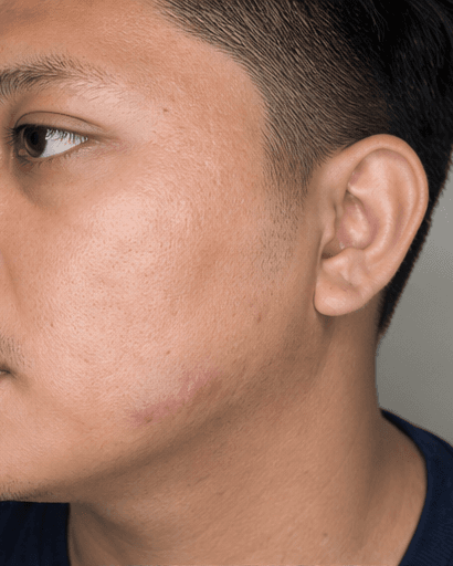 Keloid Management: after