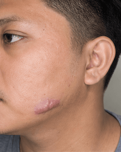 Keloid Management: before