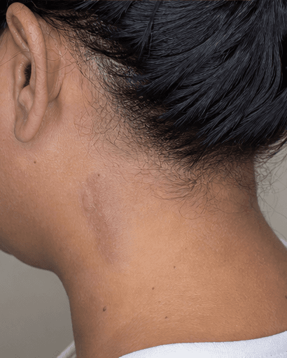 Keloid Management: after