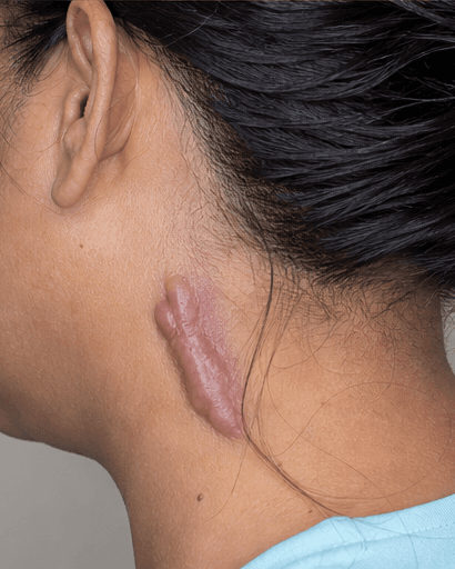 Keloid Management: before