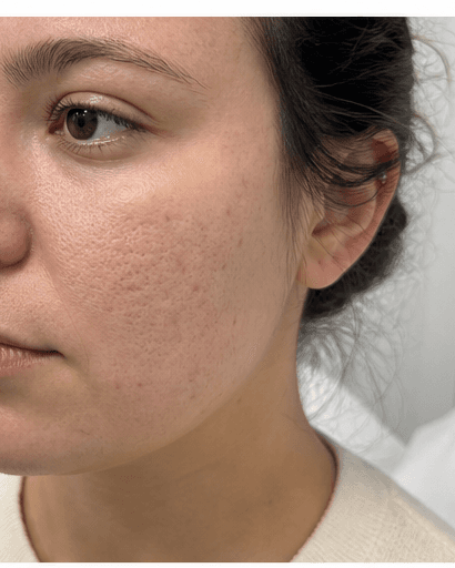 Microneedling: after