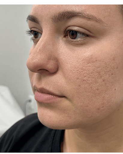Microneedling: before