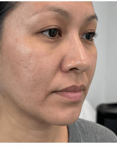 Microneedling: after