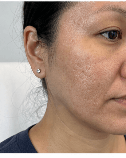 Microneedling: before