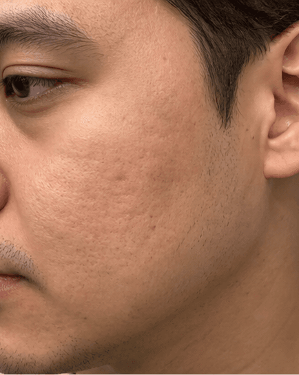 Microneedling for Scars: after