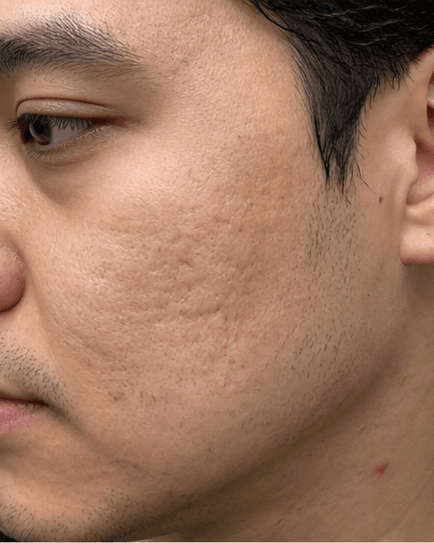 Microneedling for Scars: before